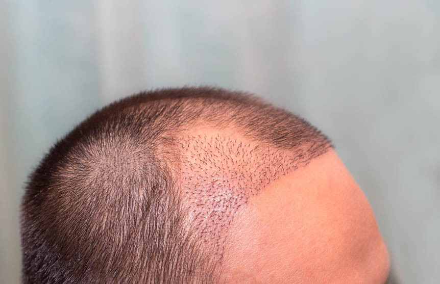 איך מתבצע טיפול השתלת שיער המושתלים בישראל